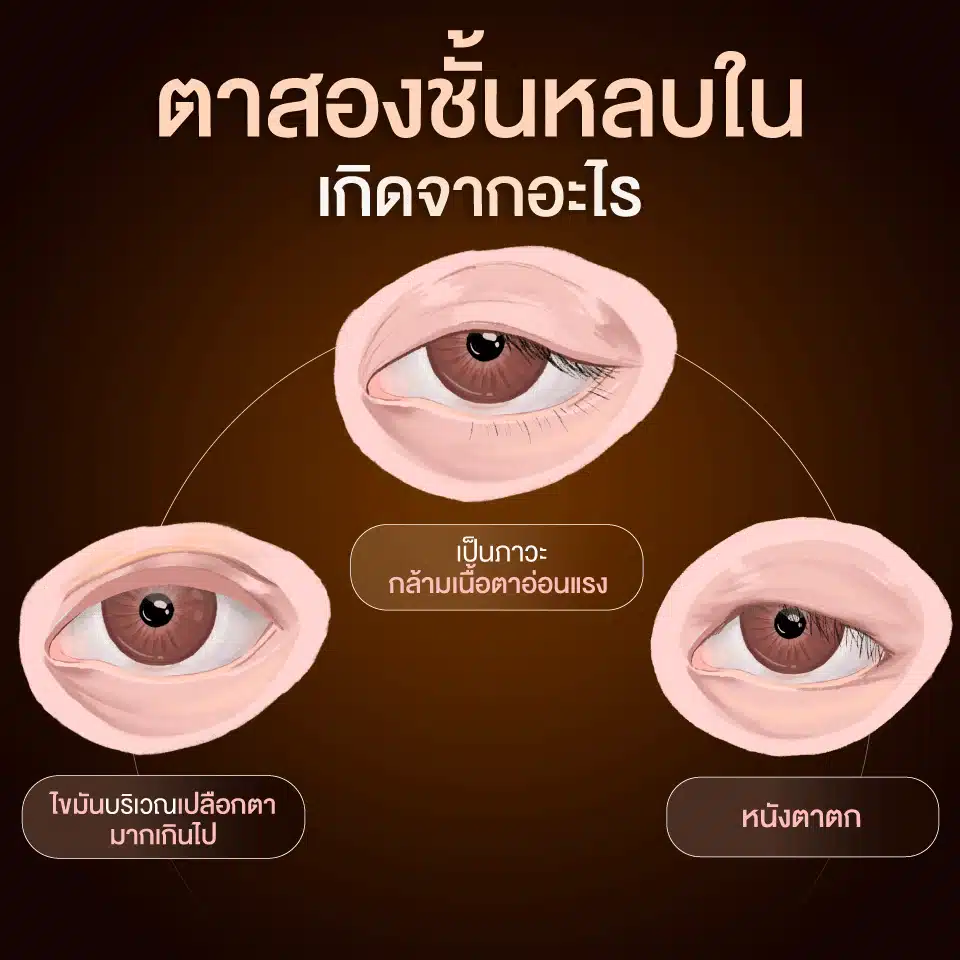 ตาสองชั้นหลบในเกิดจากอะไร
