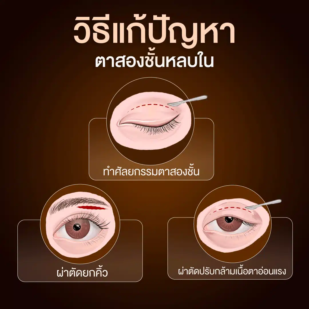 วิธีแก้ปัญหาตาสองชั้นหลบใน