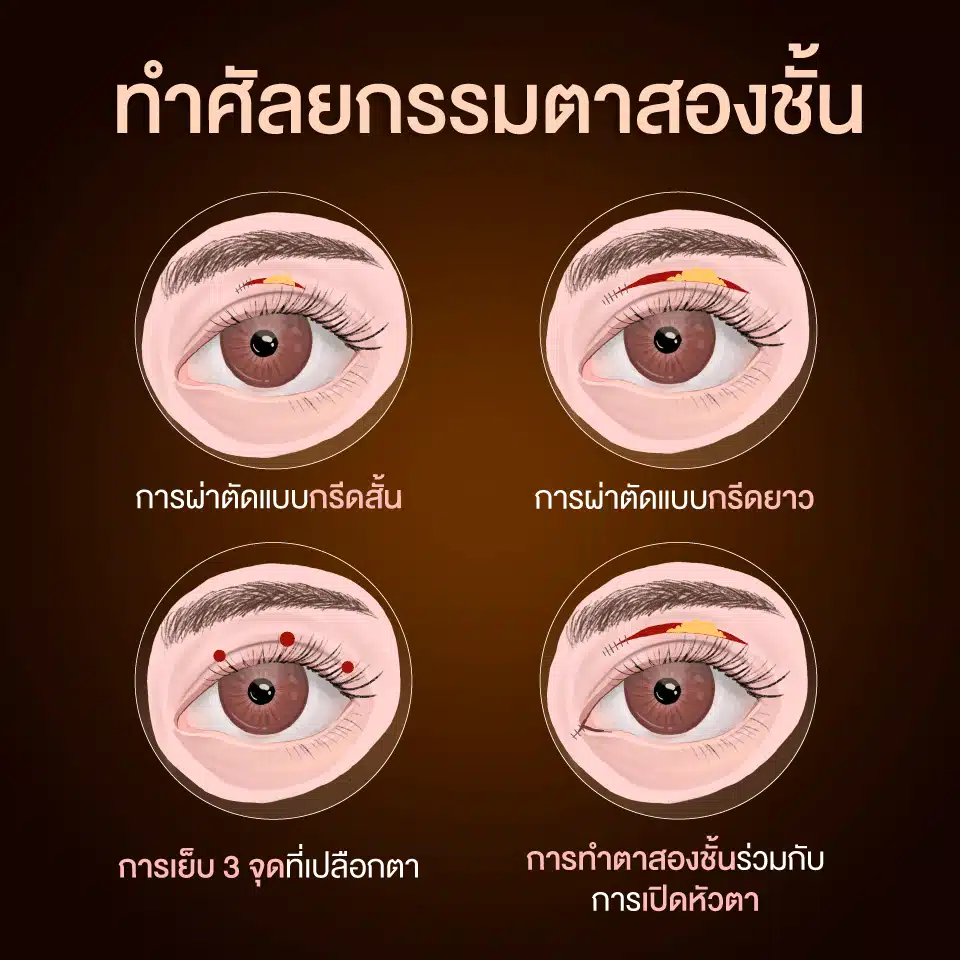 ทำศัลยกรรมตาสองชั้น