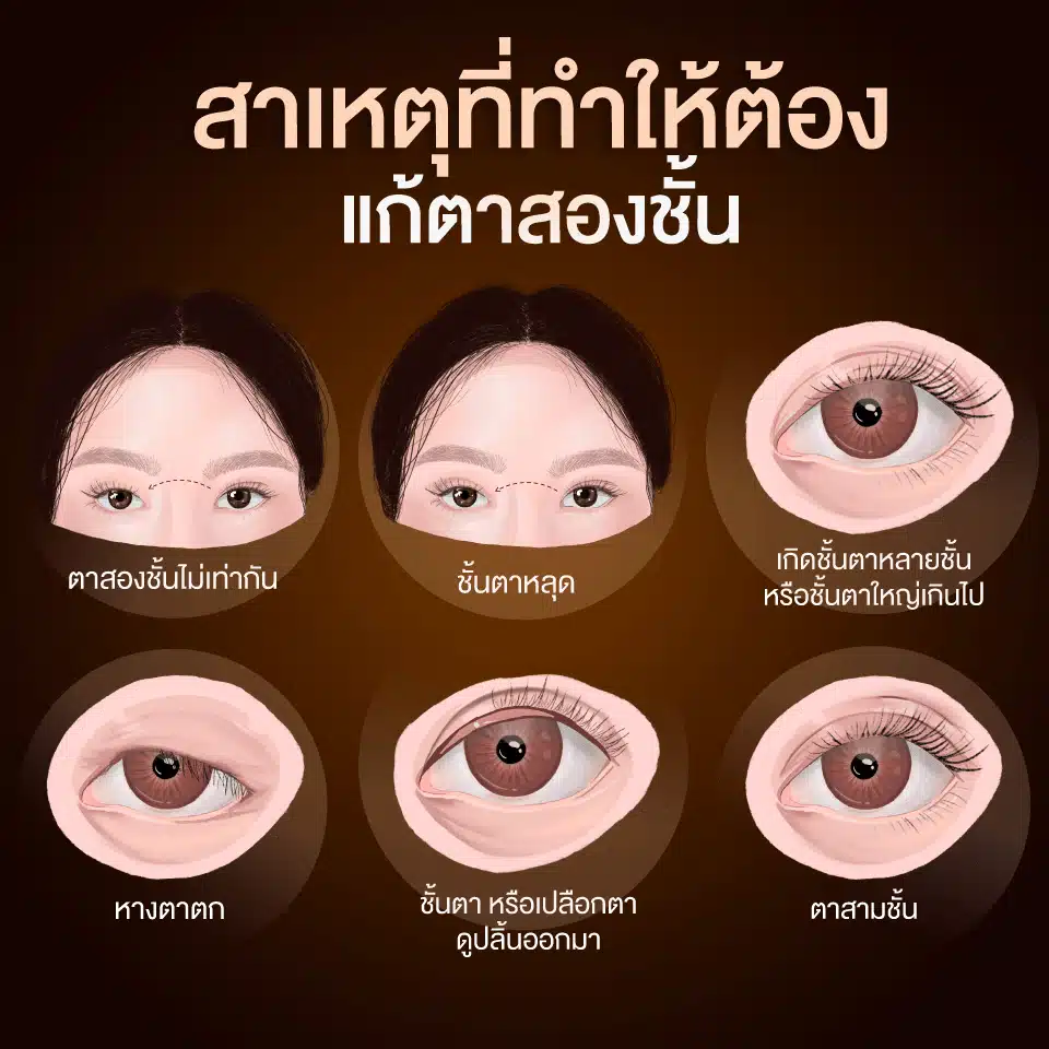 สาเหตุที่ทำให้ต้องแก้ตาสองชั้น