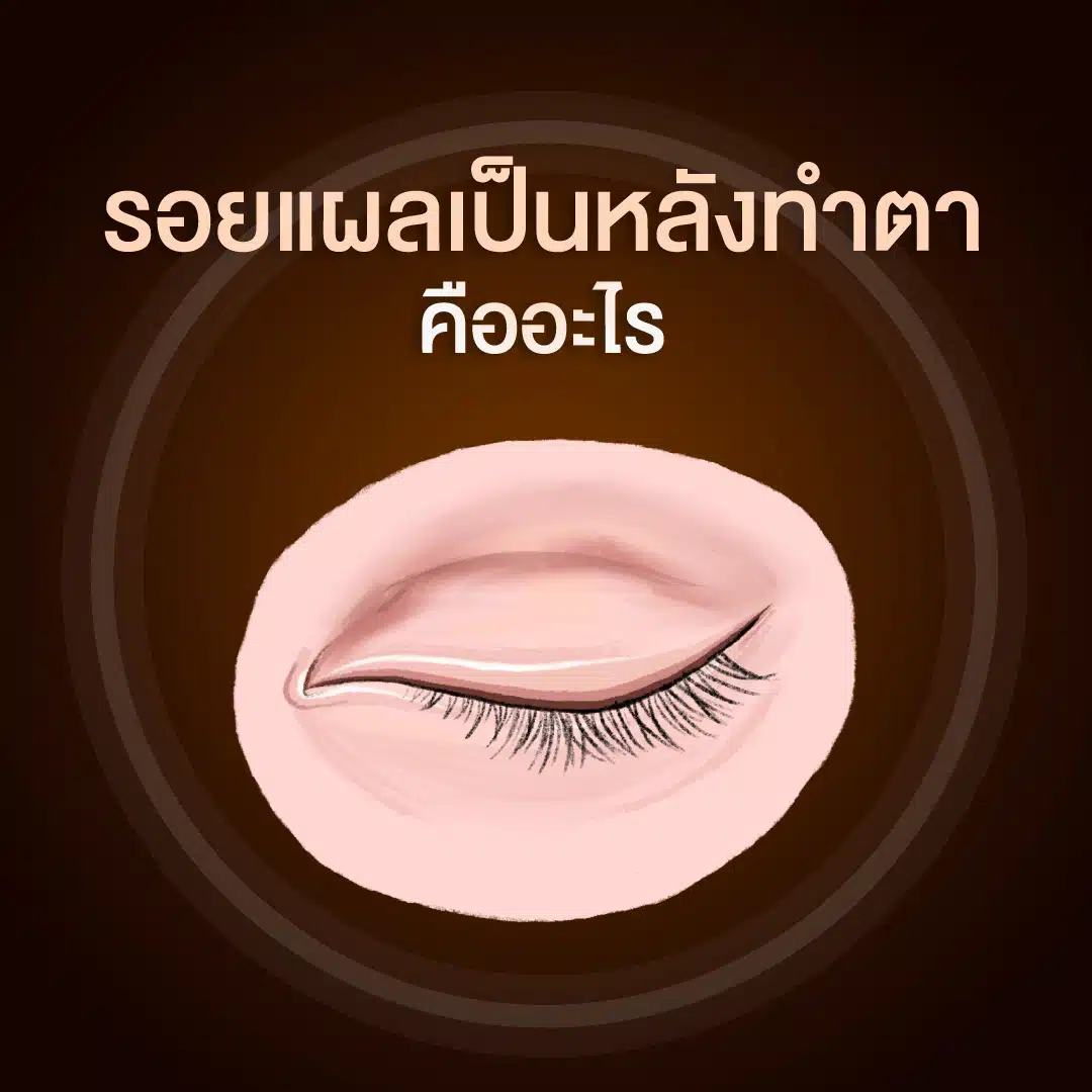 รอยแผลเป็นหลังทำตา คืออะไร
