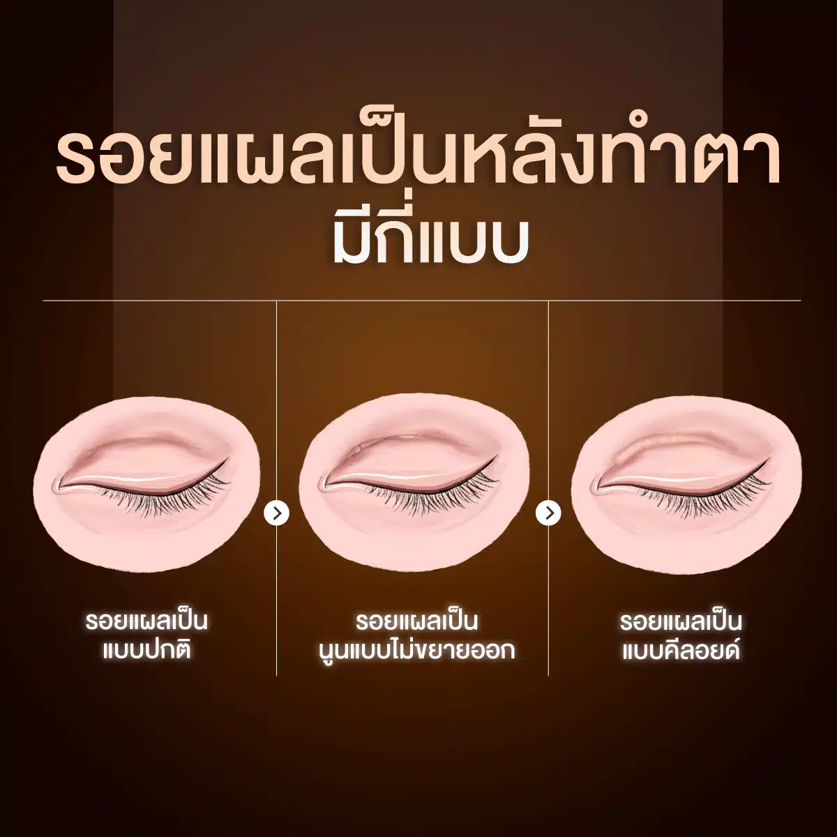รอยแผลเป็นหลังทำตา มีกี่แบบ