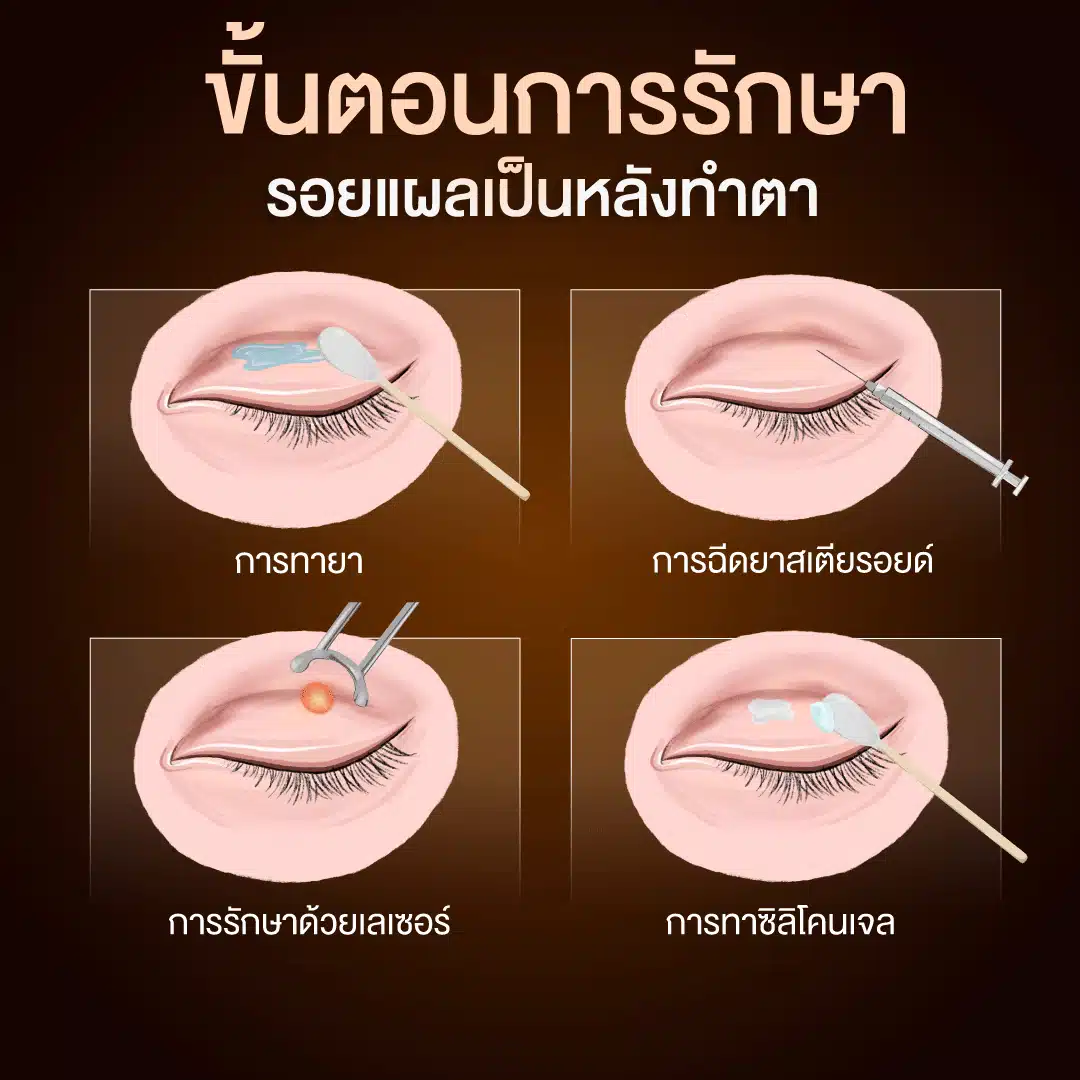 ขั้นตอนการรักษารอยแผลเป็นหลังทำตา