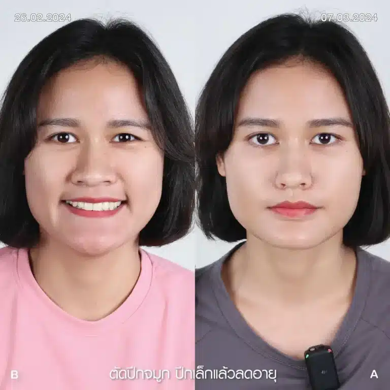 รีวิวตัดปีกจมูก 02