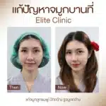 รีวิวตัดปีกจมูก 02