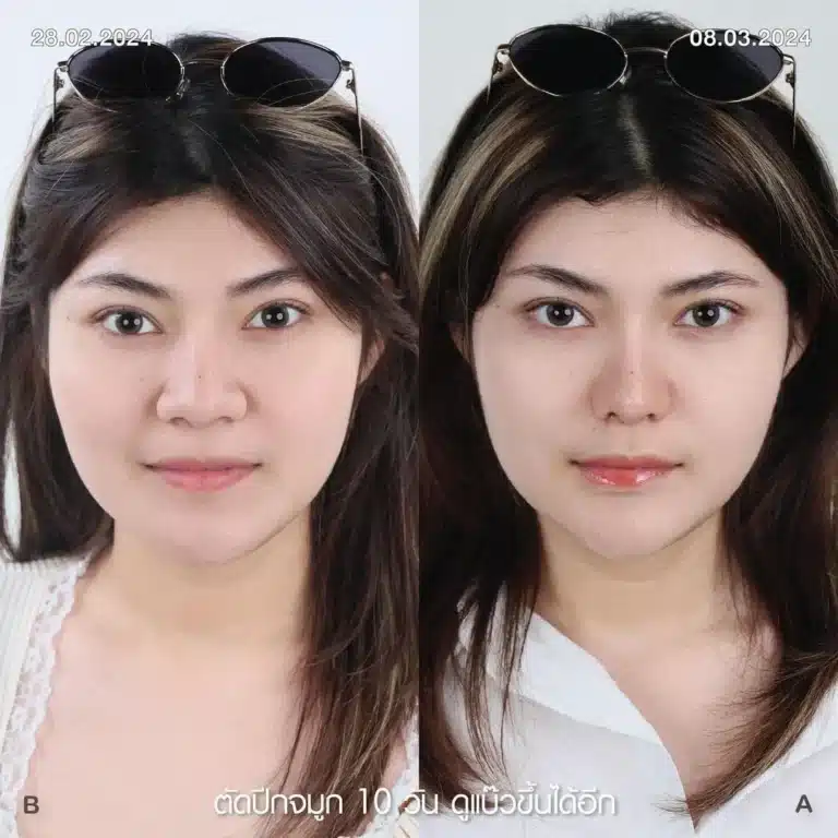 รีวิวตัดปีกจมูก 03