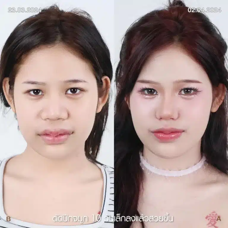 รีวิวตัดปีกจมูก 04