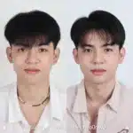 รีวิวตัดปีกจมูก 04