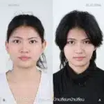 รีวิวตัดปีกจมูก 06