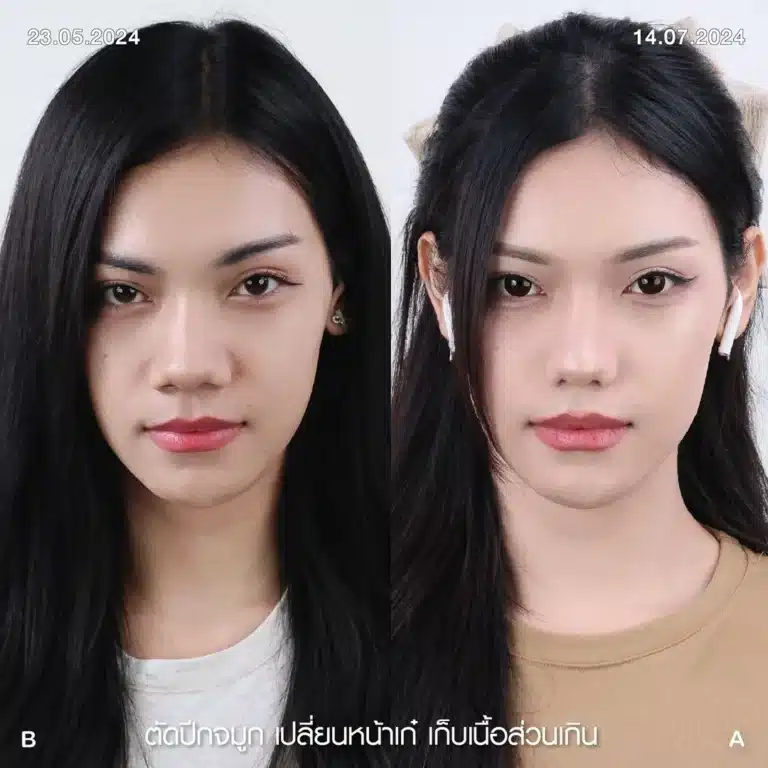 รีวิวตัดปีกจมูก 08
