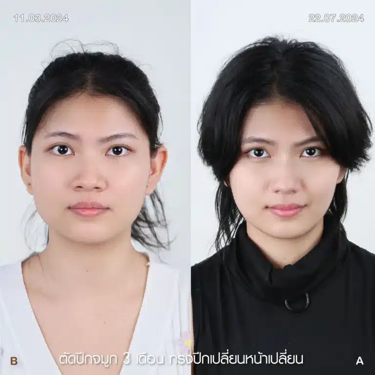 รีวิวตัดปีกจมูก 09