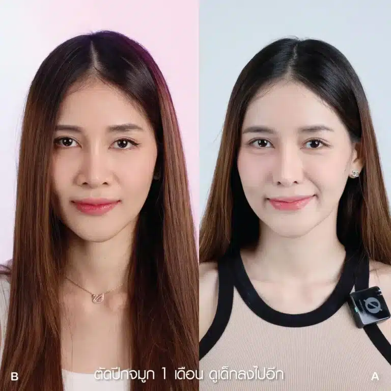 รีวิวตัดปีกจมูก 11