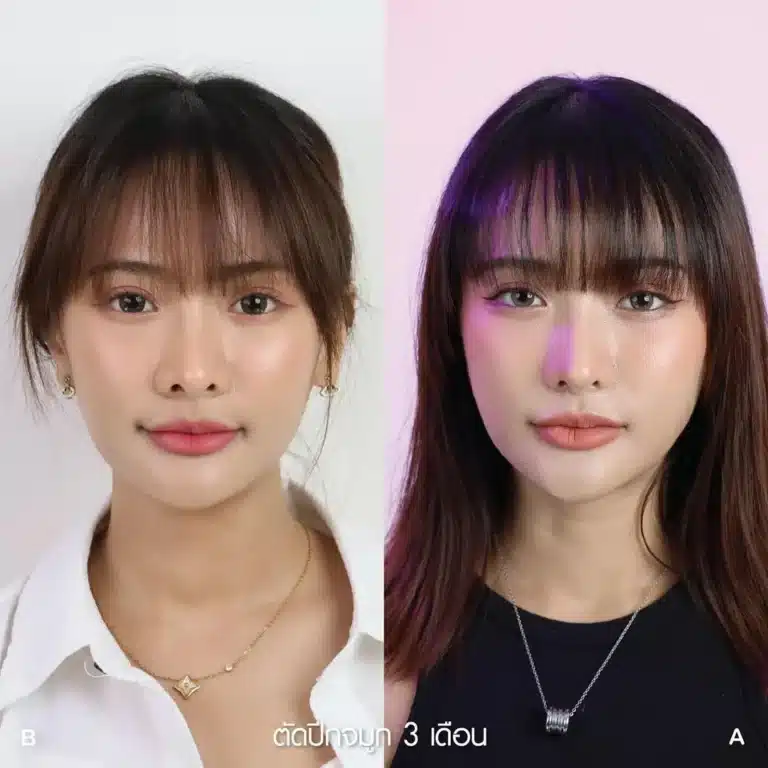 รีวิวตัดปีกจมูก คุณสปาย 01