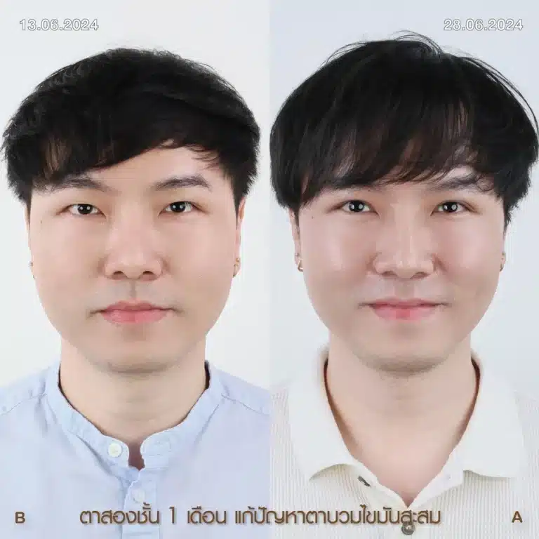 รีวิวทำตา 2 ชั้น 01