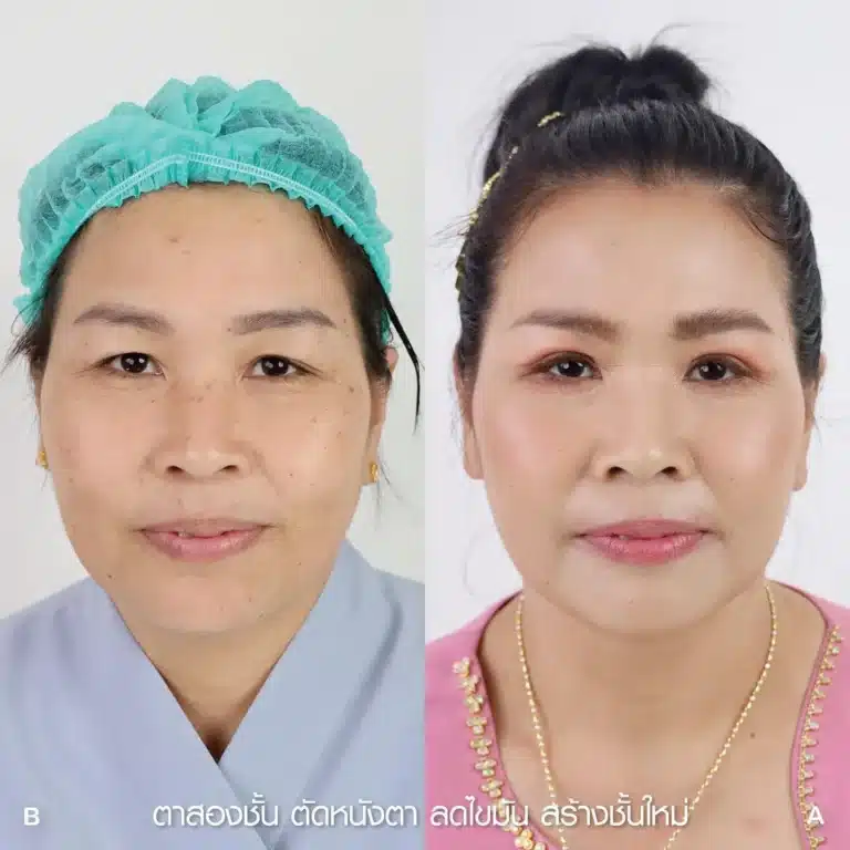 รีวิวทำตา 2 ชั้น 02