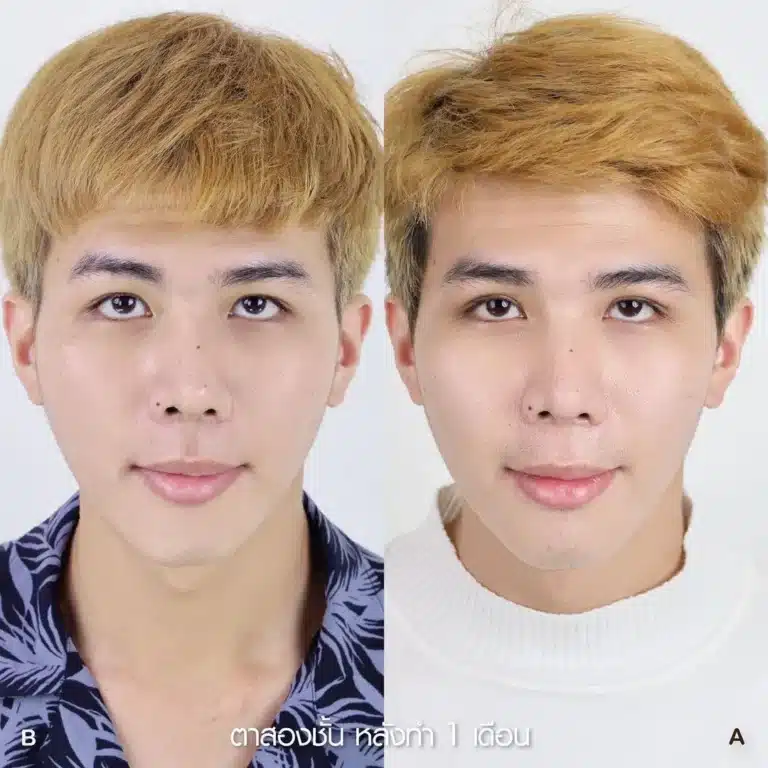 รีวิวทำตา 2 ชั้น 03