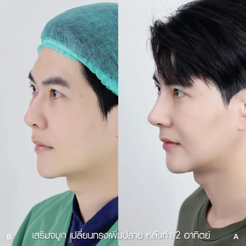 รีวิวเสริมจมูก 01