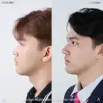รีวิวเสริมจมูก 01