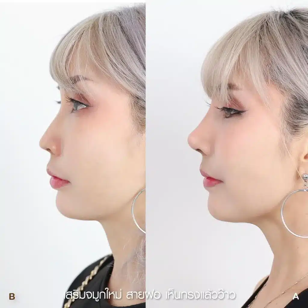 รีวิวเสริมจมูก 02