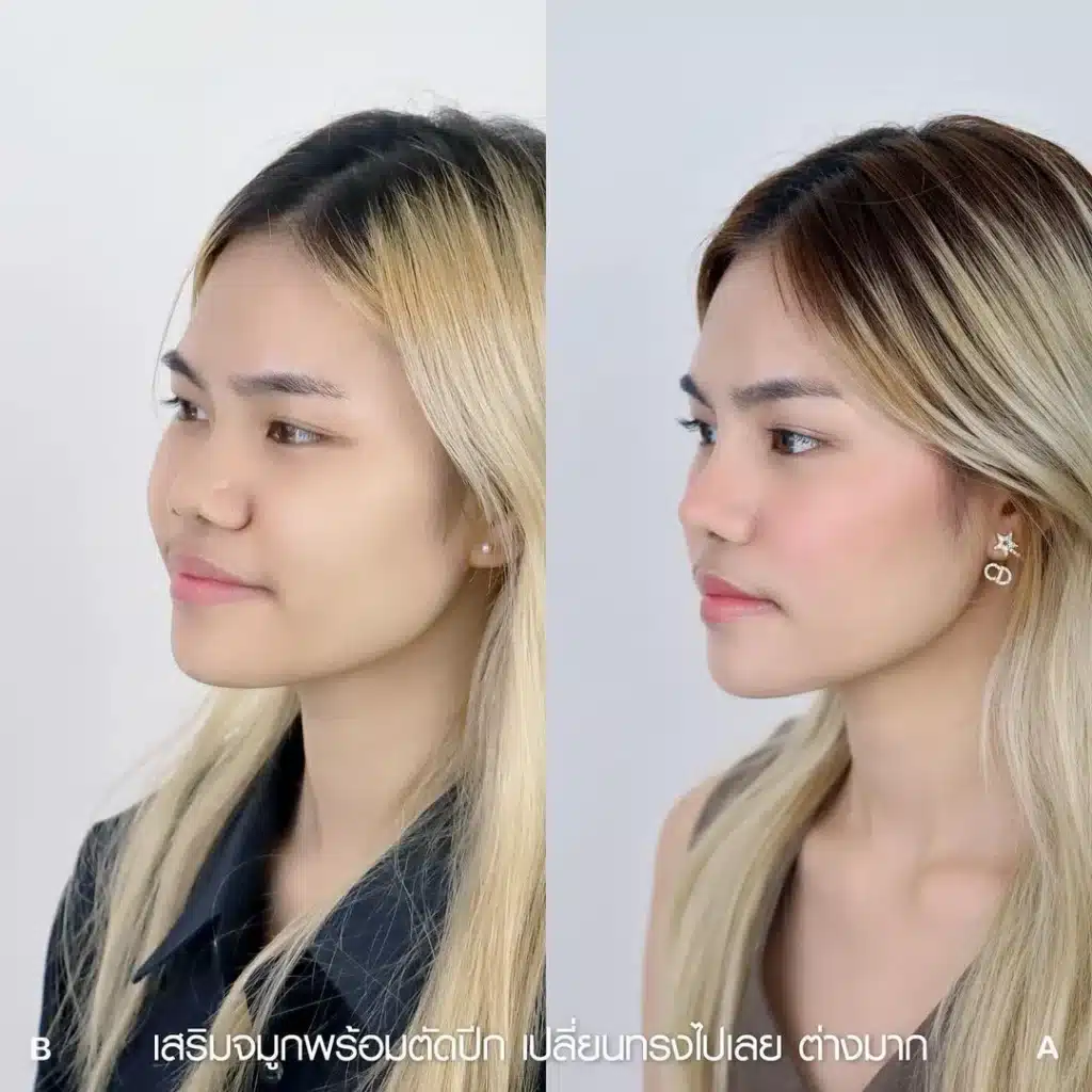 รีวิวเสริมจมูก 03