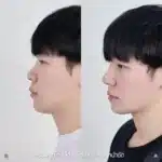 รีวิวเสริมจมูก 03