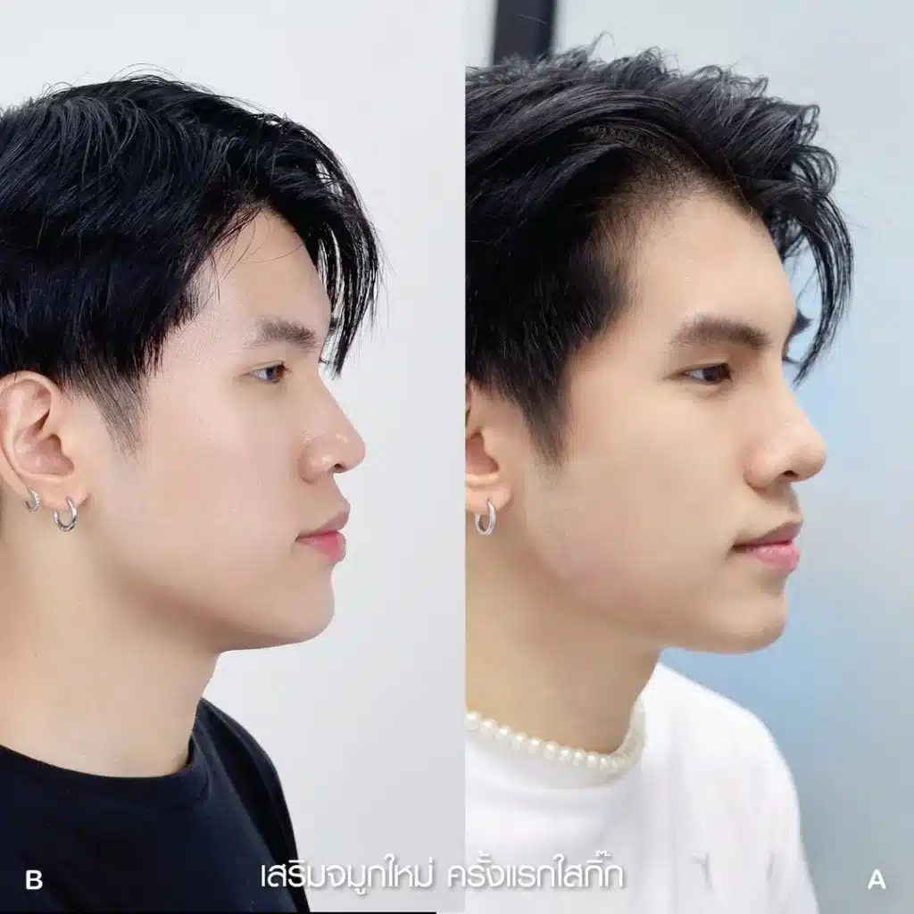 รีวิวเสริมจมูก 04