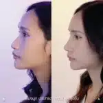 รีวิวเสริมจมูก 04_001