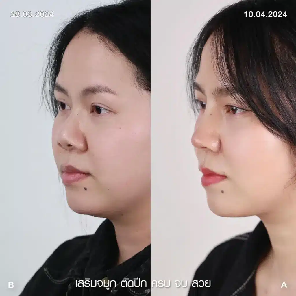 รีวิวเสริมจมูก 05