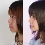 รีวิวเสริมจมูก 05_001