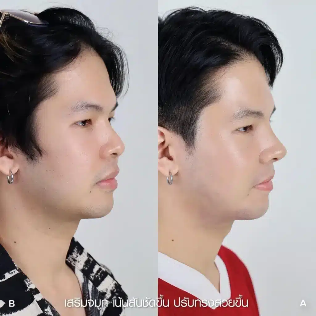 รีวิวเสริมจมูก 05