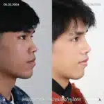 รีวิวเสริมจมูก 06_001