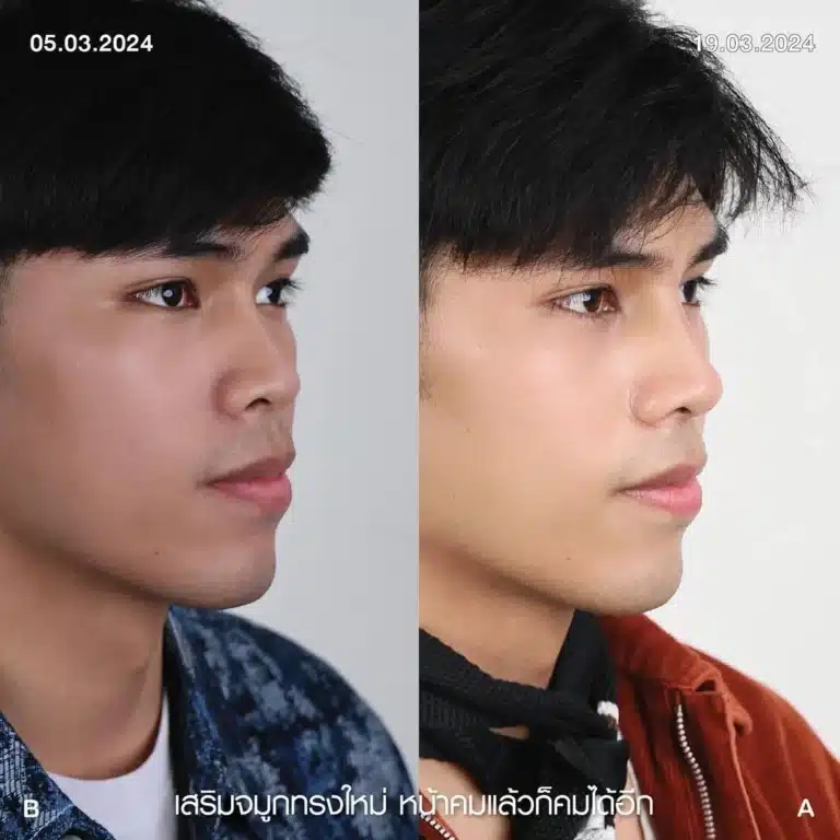 รีวิวทำจมูกผู้ชาย ก่อน-หลัง ที่ Elite Clinic