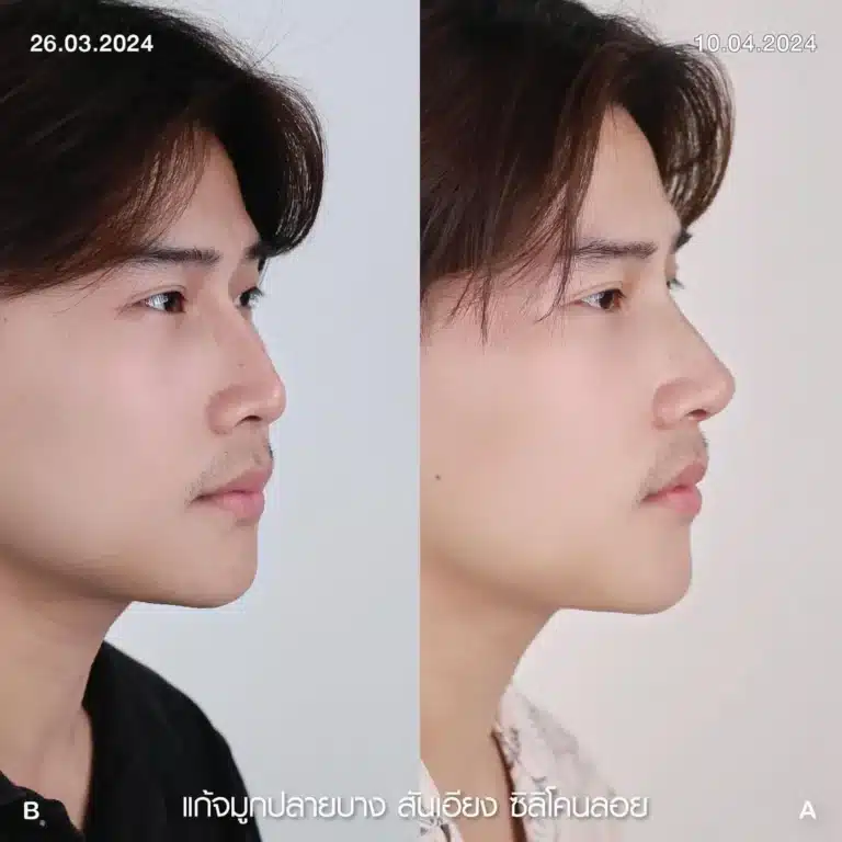 รีวิวทำจมูกผู้ชาย ก่อน-หลัง ที่ Elite Clinic