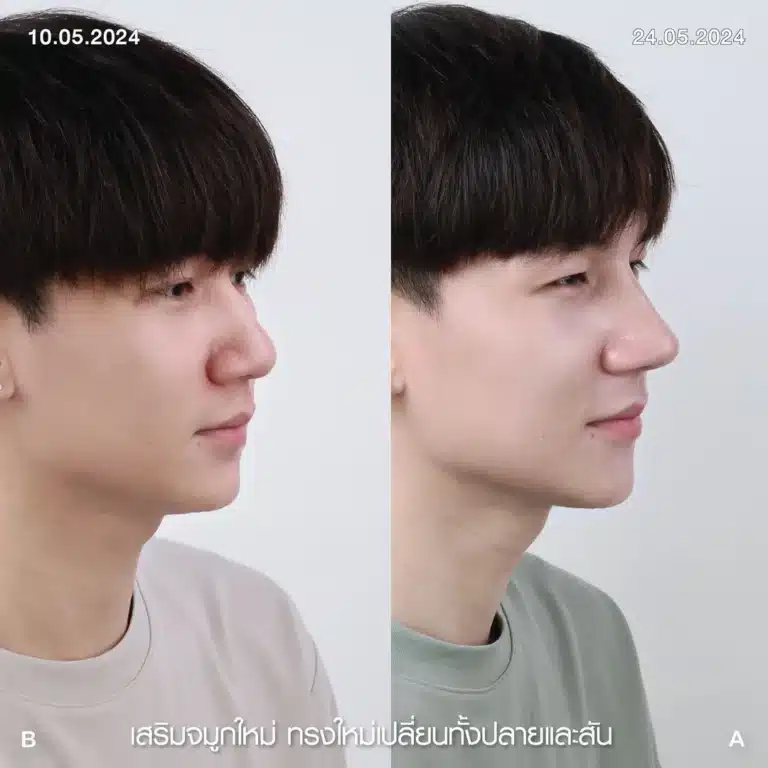 รีวิวทำจมูกผู้ชาย ก่อน-หลัง ที่ Elite Clinic