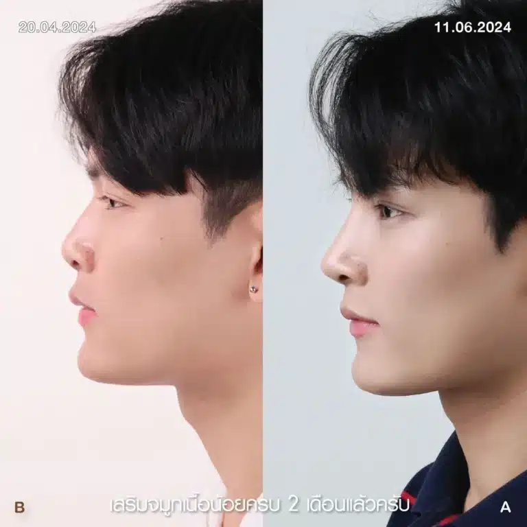 รีวิวทำจมูกผู้ชาย ก่อน-หลัง ที่ Elite Clinic