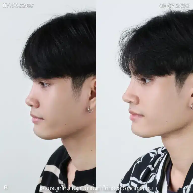 รีวิวทำจมูกผู้ชาย ก่อน-หลัง ที่ Elite Clinic