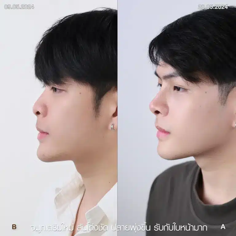รีวิวทำจมูกผู้ชาย ก่อน-หลัง ที่ Elite Clinic