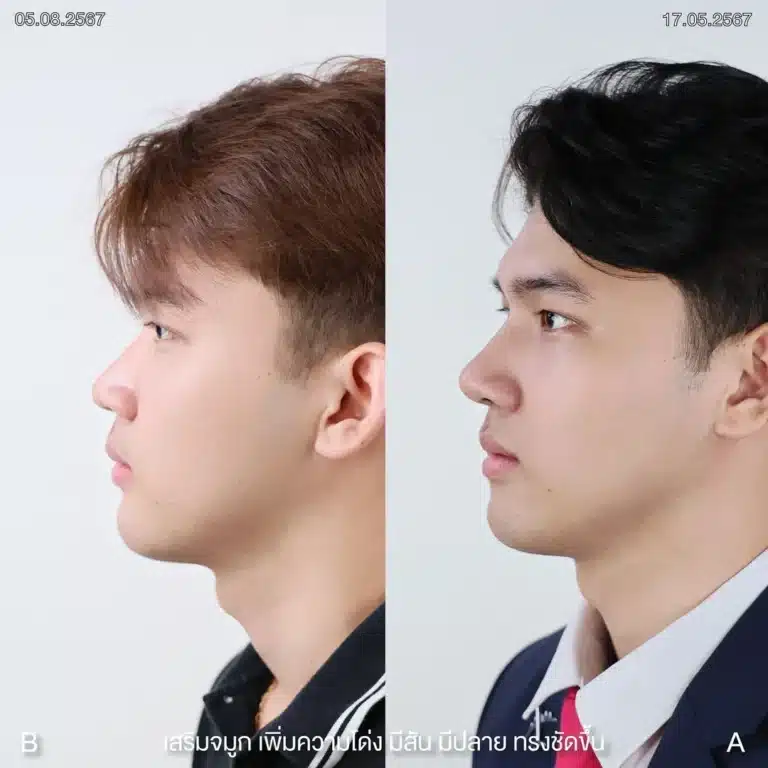 รีวิวทำจมูกผู้ชาย ก่อน-หลัง ที่ Elite Clinic