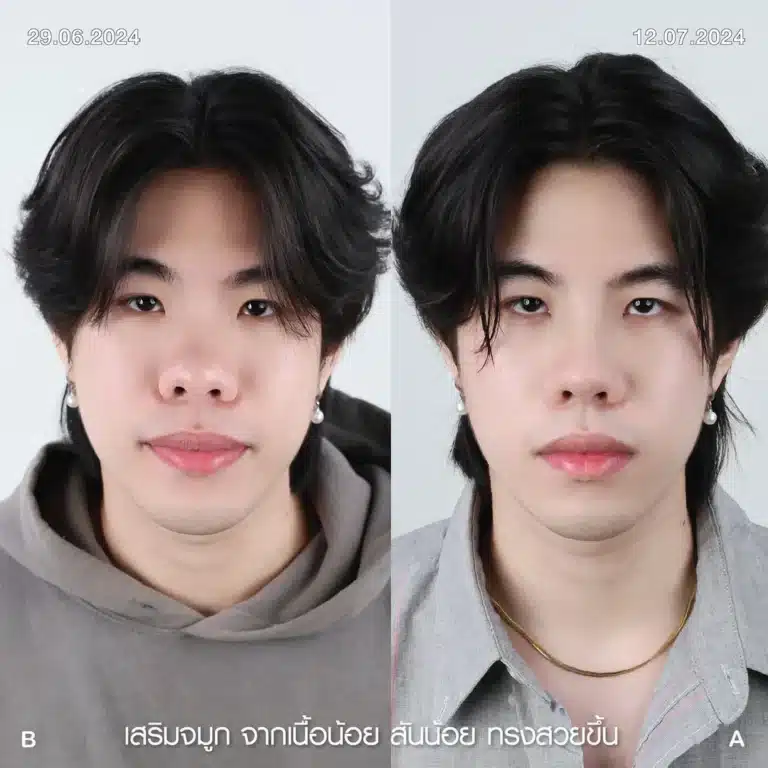 รีวิวทำจมูกผู้ชาย ก่อน-หลัง ที่ Elite Clinic