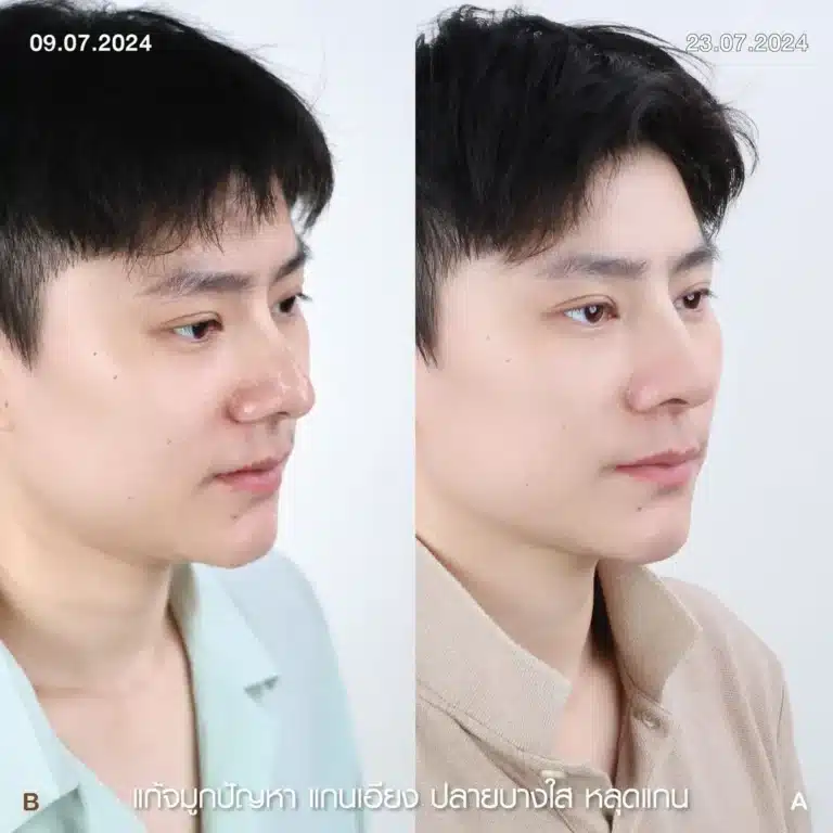 รีวิวทำจมูกผู้ชาย ก่อน-หลัง ที่ Elite Clinic