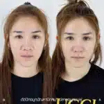 รีวิวแก้จมูกใหญ่ จมูกชมพู่ 01