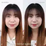 รีวิวแก้จมูกใหญ่ จมูกชมพู่ 02