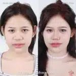 รีวิวแก้จมูกใหญ่ จมูกชมพู่ 03