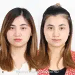รีวิวแก้จมูกใหญ่ จมูกชมพู่ 04
