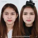 รีวิวแก้จมูกใหญ่ จมูกชมพู่ 06