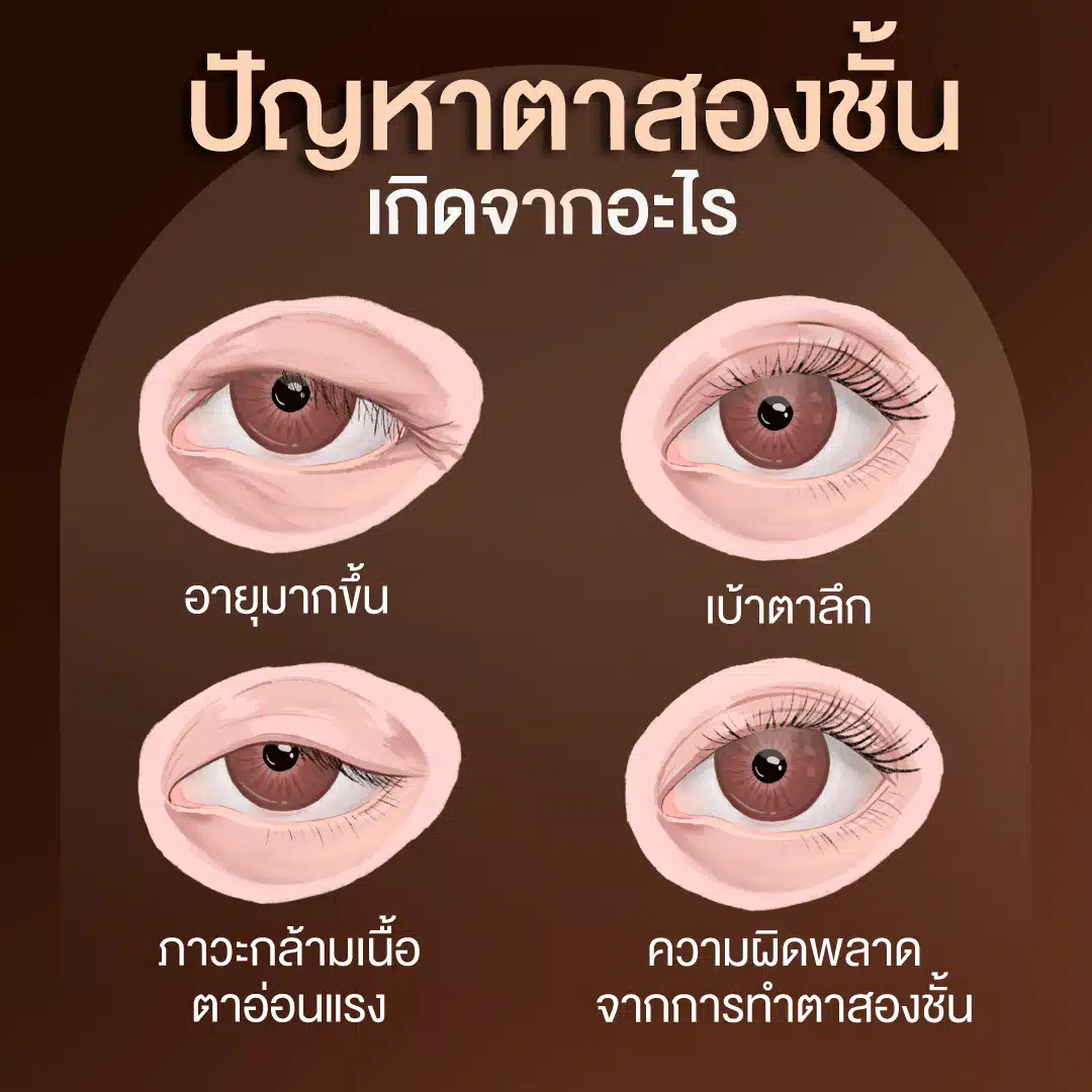 ตาสามชั้น เกิดจากอะไร