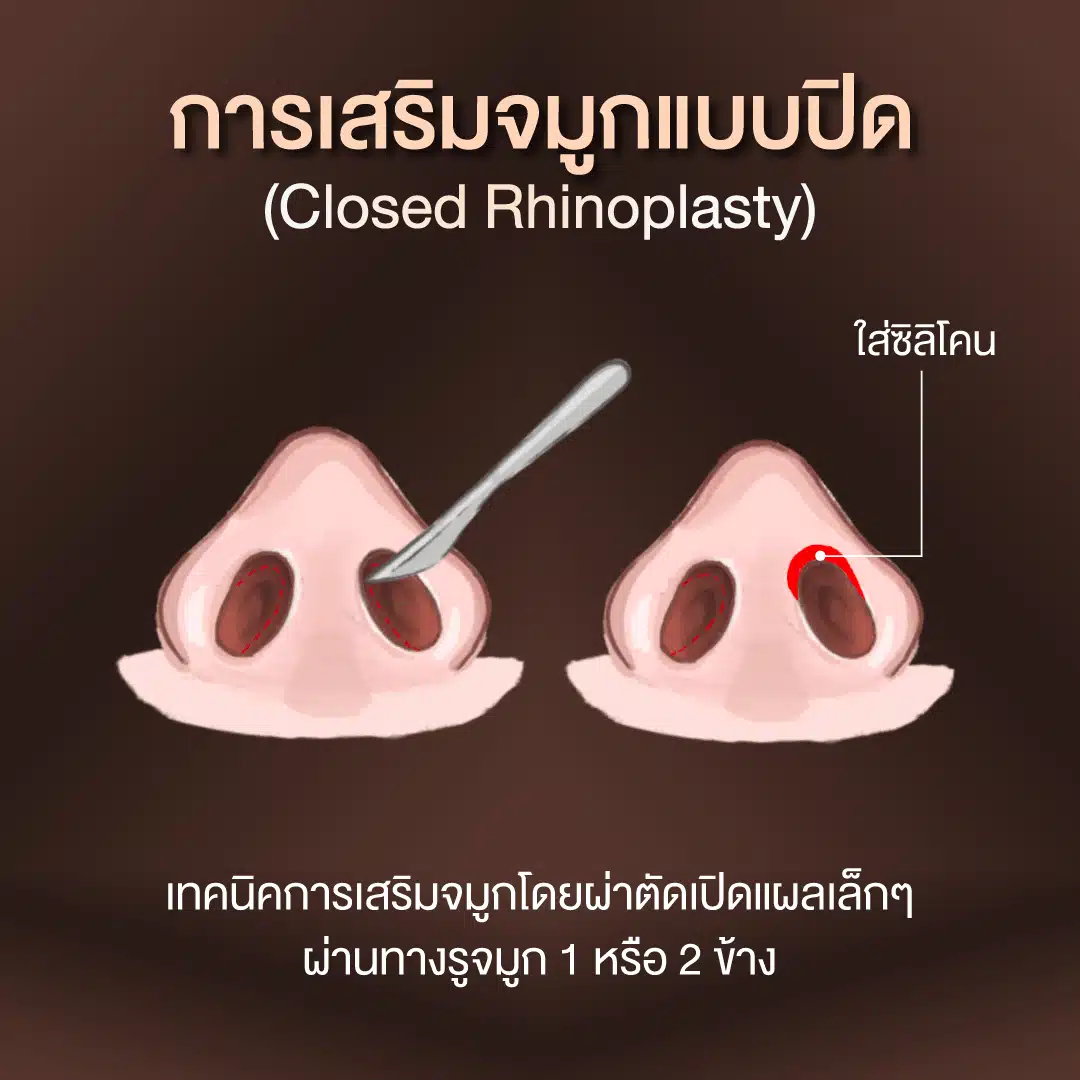 การเสริมจมูกแบบปิดคืออะไร