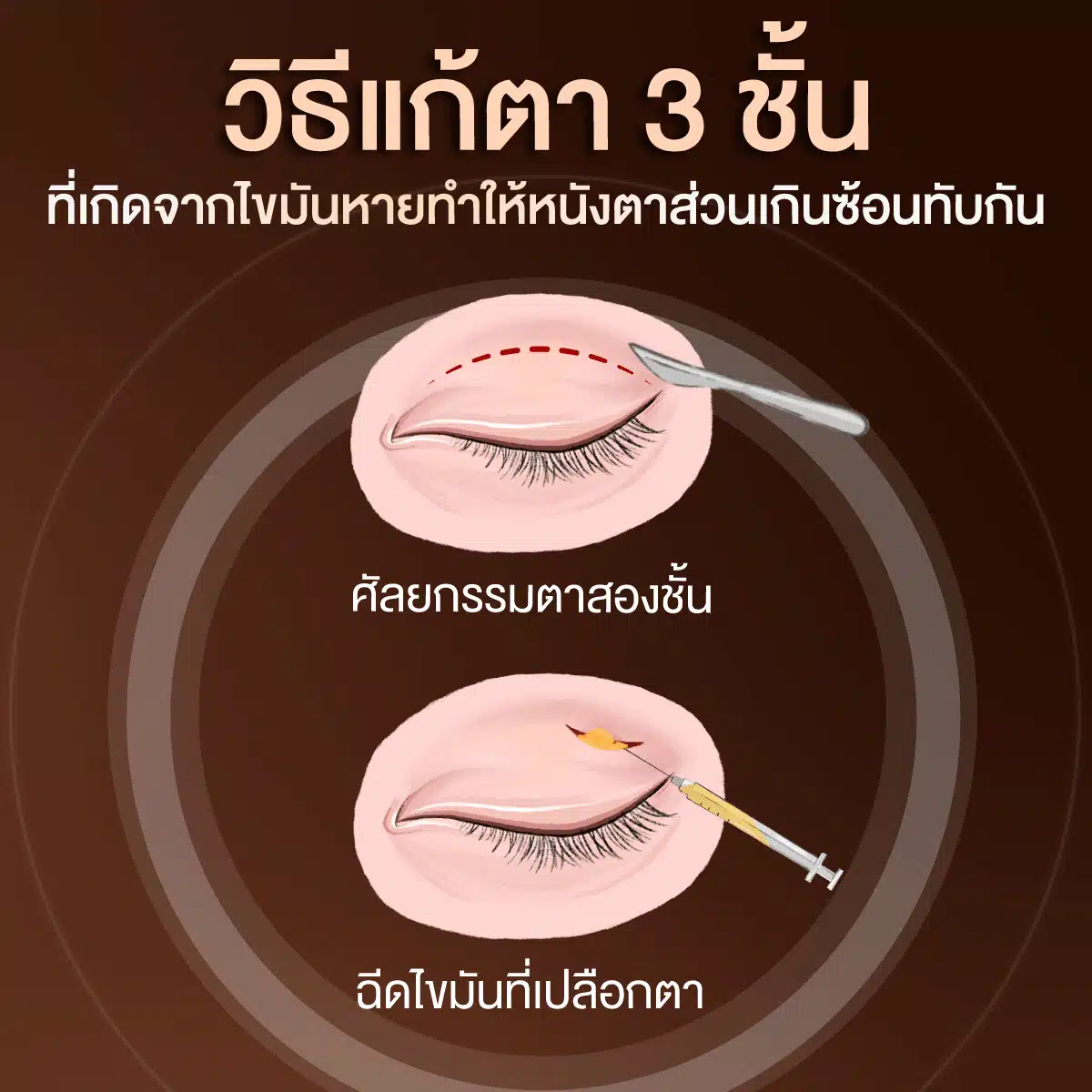 วิธีแก้ตา 3 ชั้น