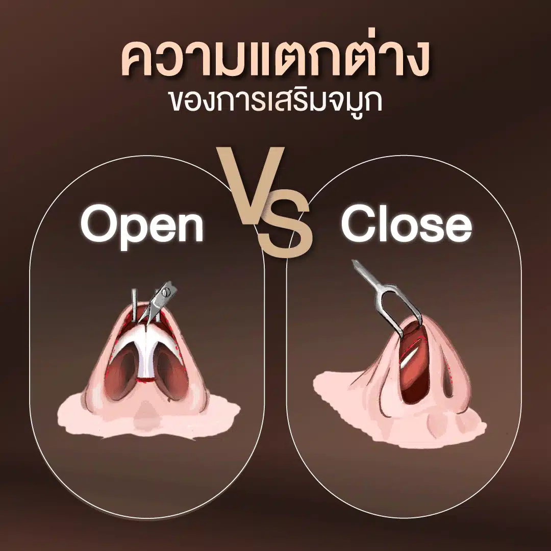 การเสริมจมูก Close VS Open ต่างกันอย่างไร