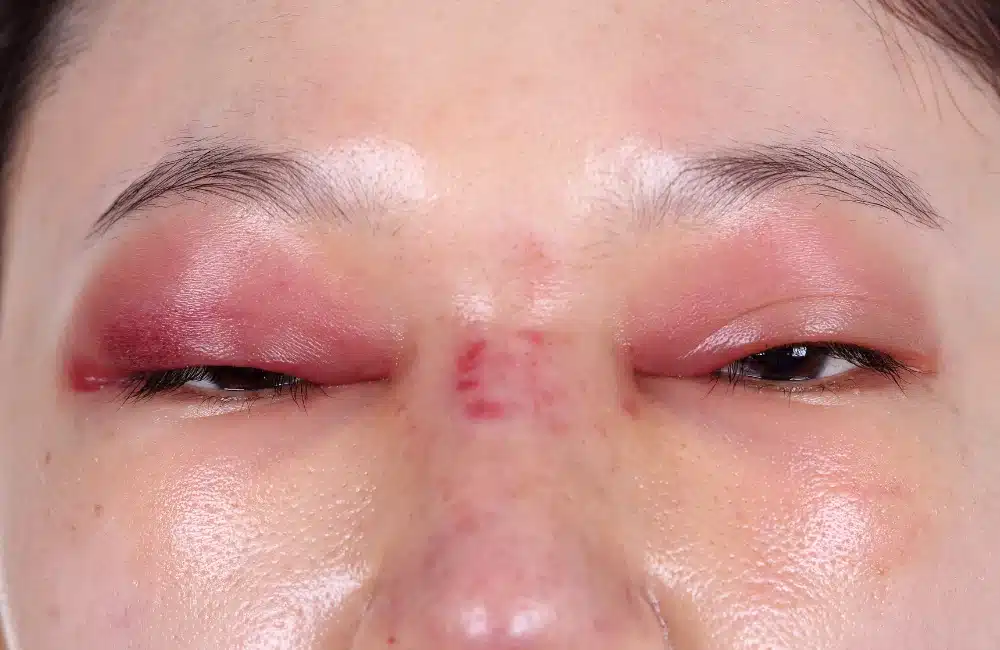 เช็กอาการหลังเสริมจมูกแต่ละช่วงเวลา